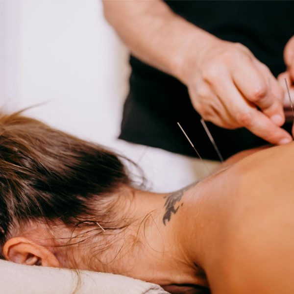 Acupuncturist applying fine needles at Restoracare Health