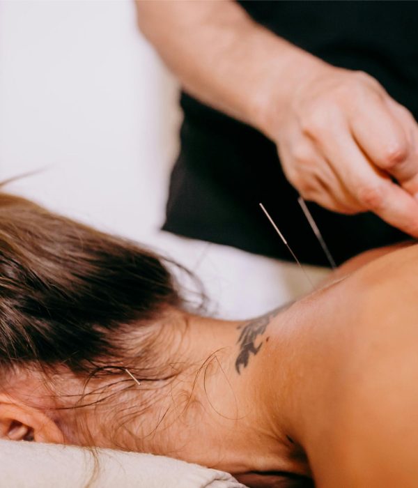 Acupuncturist applying fine needles at Restoracare Health