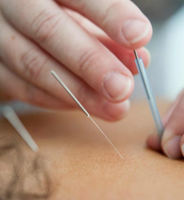 Acupuncture toronto