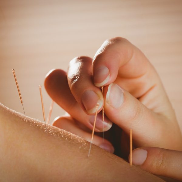 Acupuncture Shoulder