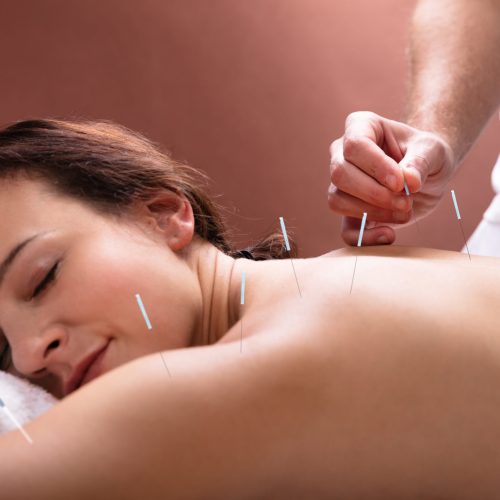 Close-up Of Relaxed Young Woman Going Through Acupuncture Treatment In Spa